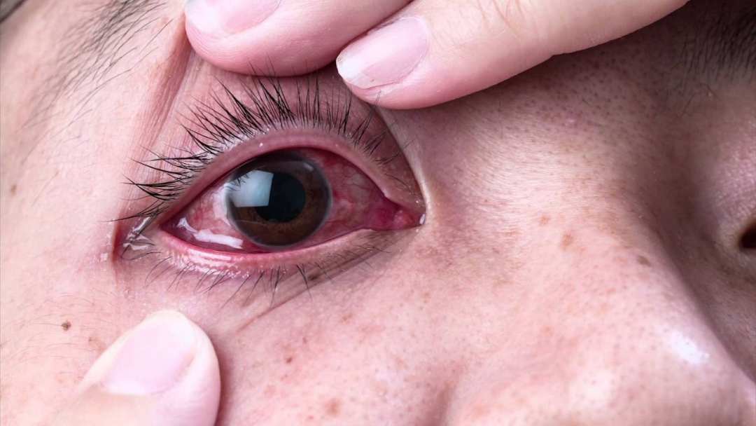 Bệnh đau mắt đỏ là một bệnh lành tính và phổ biến