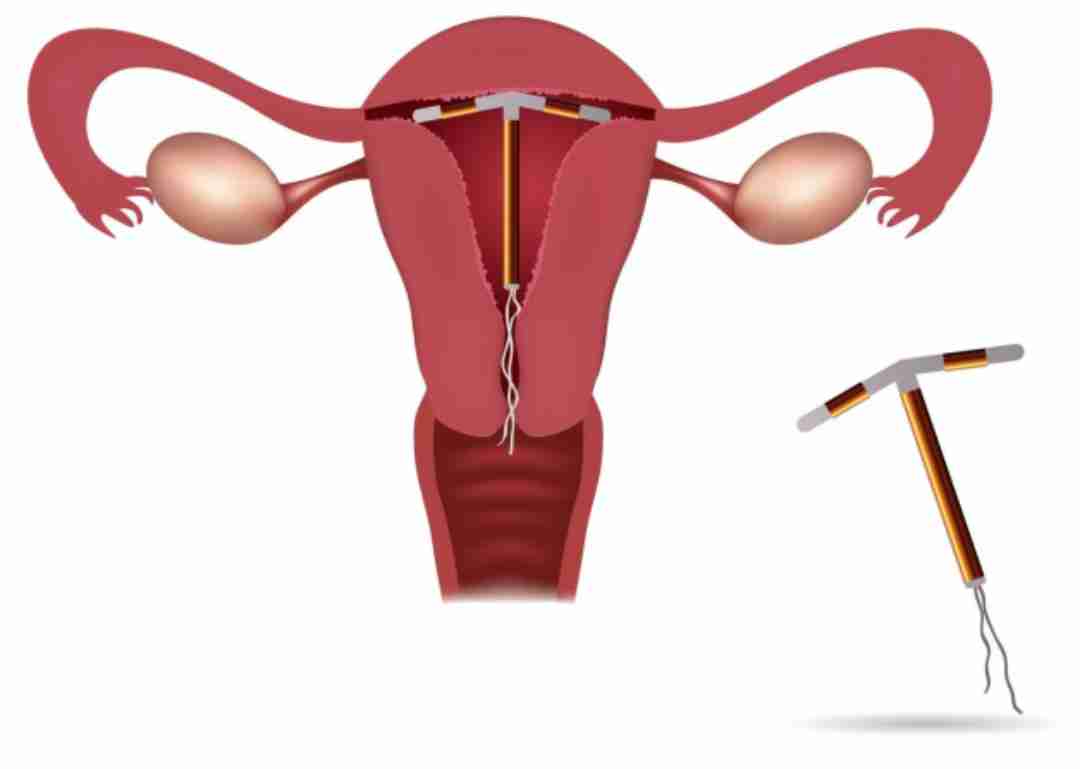 Vị trí đặt vòng tránh thai an toàn 