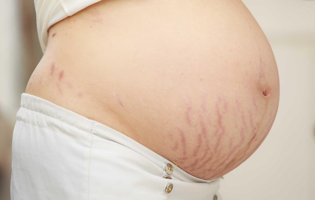 Vết rạn da phổ biến trên cơ thể mẹ bầu