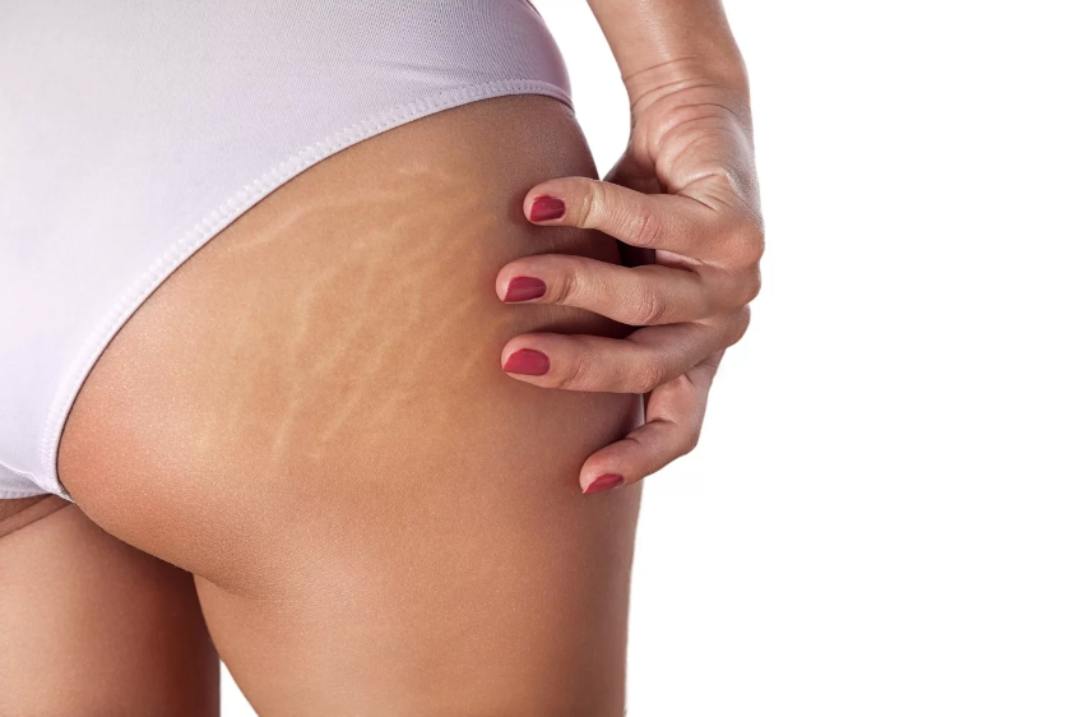 Độ ẩm tốt giúp phần da bị rạn nhanh cải thiện