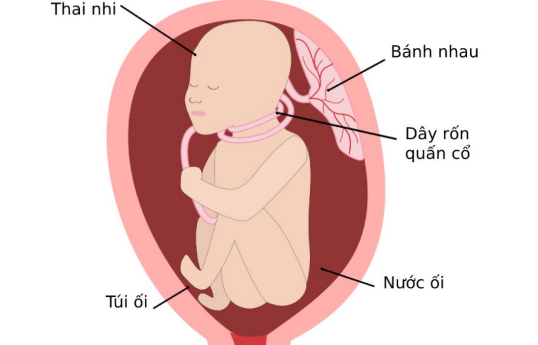 Bé bị tràng hoa quấn cổ sẽ thông minh?