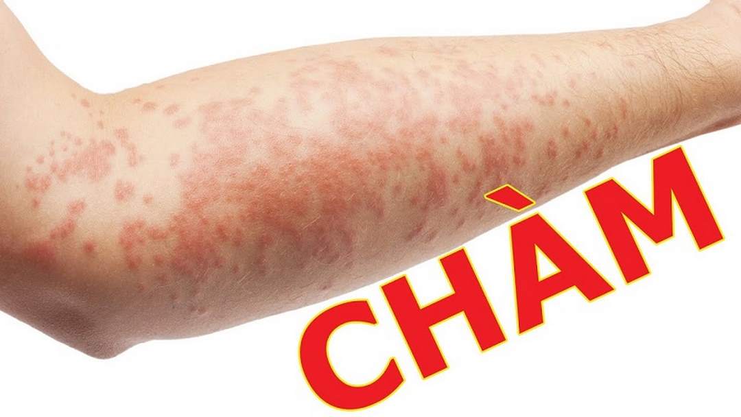 Bệnh chàm (Eczema) là bệnh gì?