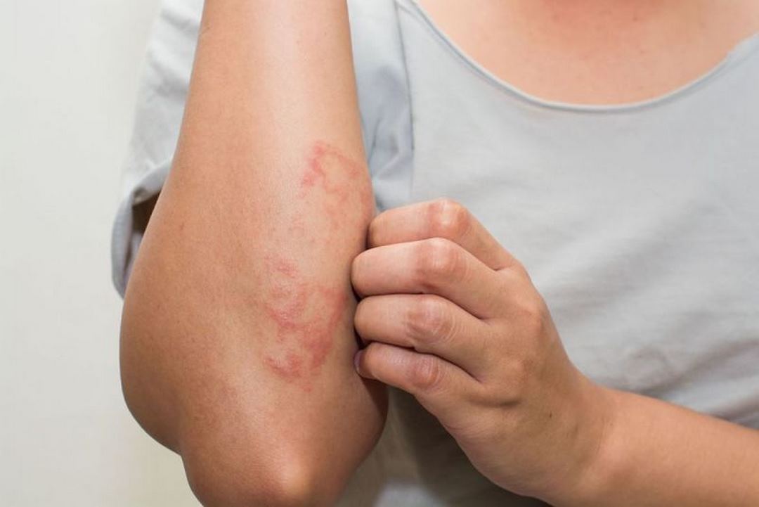 Triệu chứng của bệnh chàm - Eczema