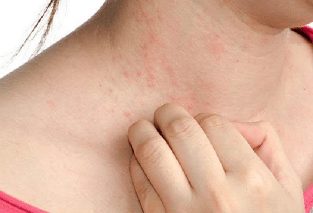 Biểu hiện cụ thể của chàm Eczema