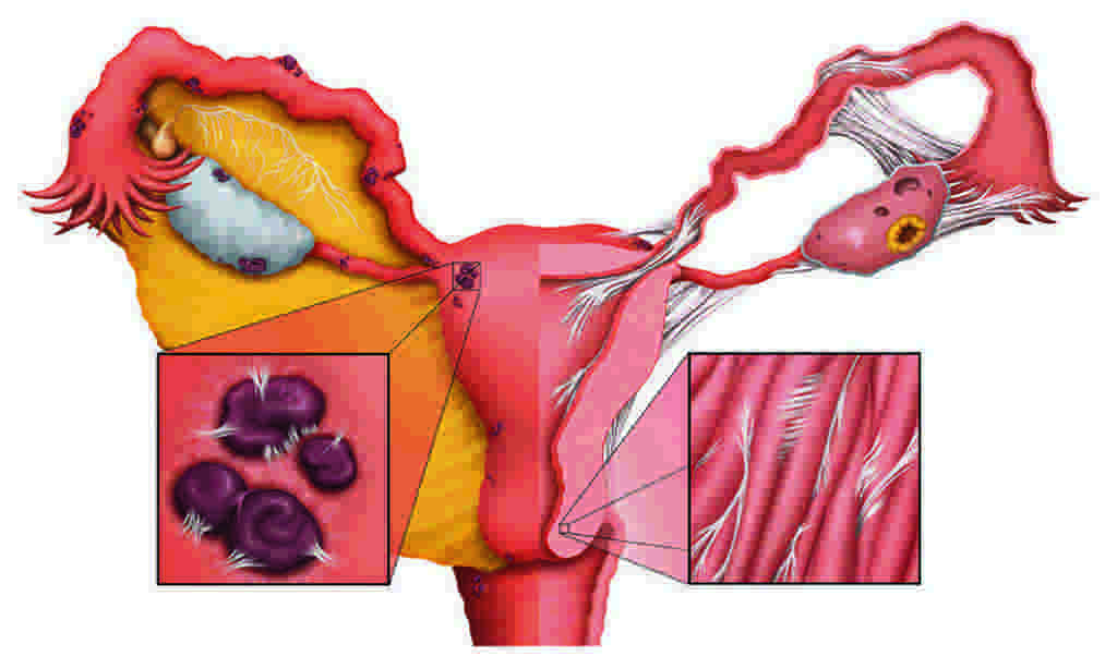 Thuốc tránh thai gây tình trạng kinh nguyệt không đều.