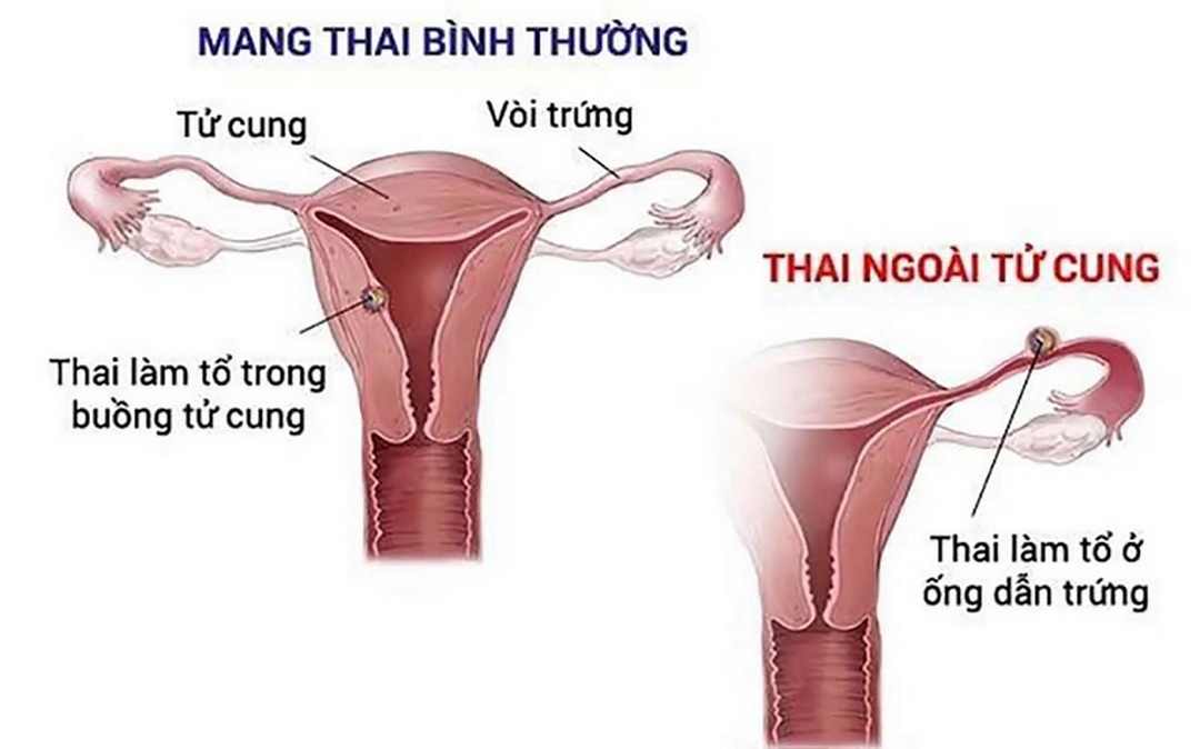 Hình ảnh mô tả mang thai bình thường và có thai ngoài tử cung