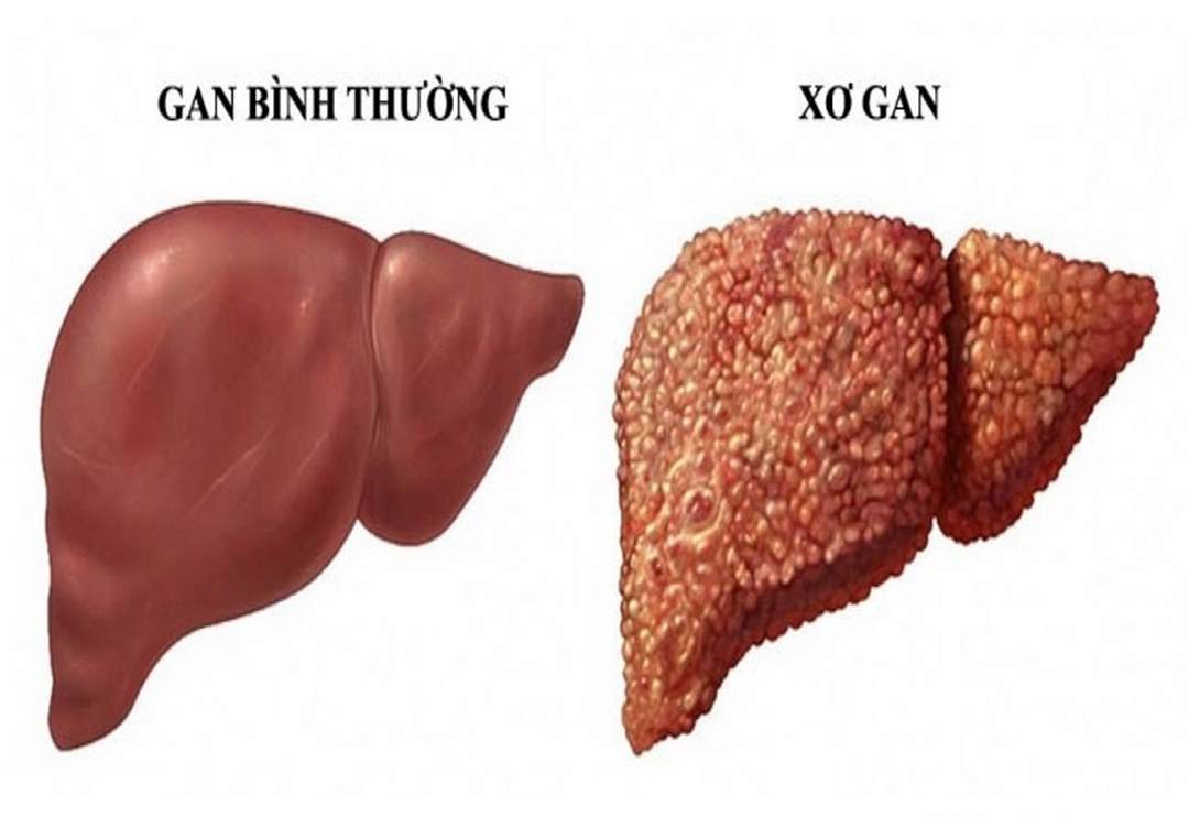 Vàng da do một số bệnh lý về gan