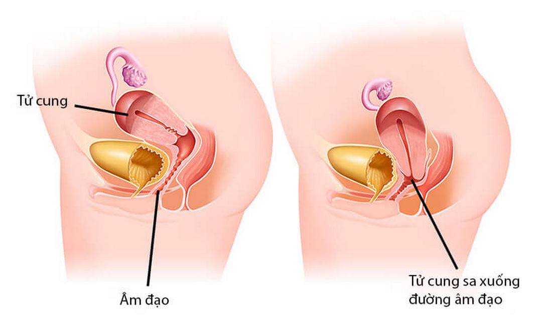 Sa tử cung là gì?