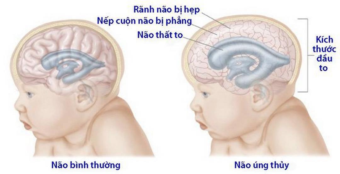 Trẻ bị giãn não thất có kích thước hộp sọ to hơn bình thường