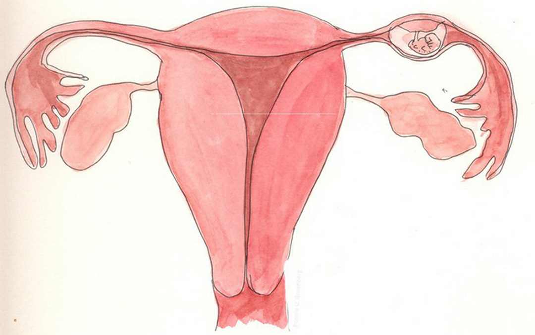 Mang thai ngoài tử cung là tình trạng thai làm tổ ở vị trí khác