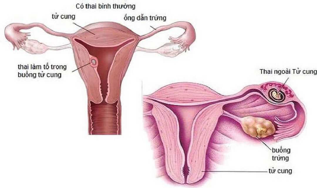 Mang thai ngoài tử cung sẽ gặp hiện tượng ra máu khi mang thai