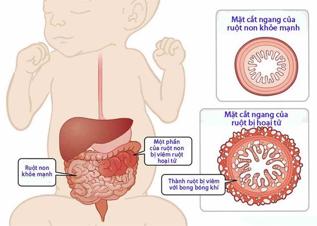 Viêm đường ruột là một trong các nguyên nhân gây tiêu chảy ở trẻ sơ sinh