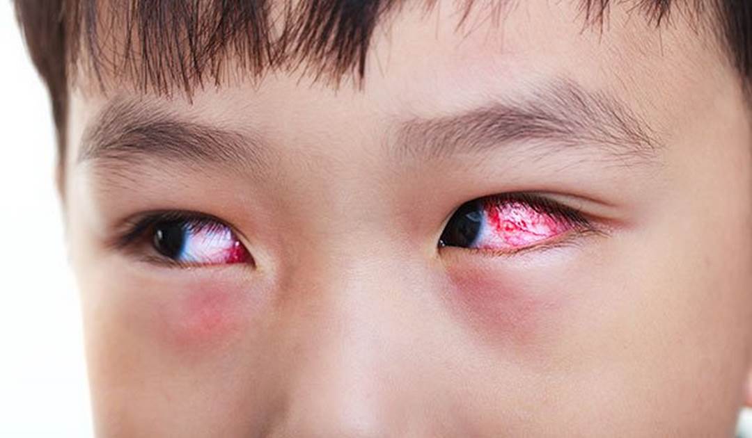 Đau mắt đỏ là gì?